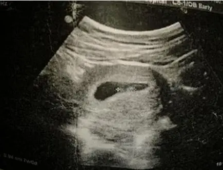 怀孕了，孕囊旁有液性暗区?那是什么?