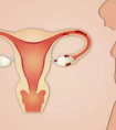 为什么我会长子宫内膜息肉 ，影响怀孕吗?