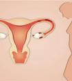 多囊卵巢患者适合人工授精还是试管婴儿？