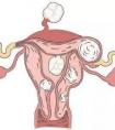 输卵管不通可以做试管婴儿生小孩吗?