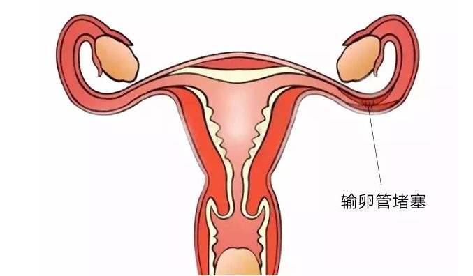 输卵管切除还能做广州试管婴儿吗？