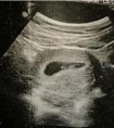 怀孕了，孕囊旁有液性暗区?那是什么?