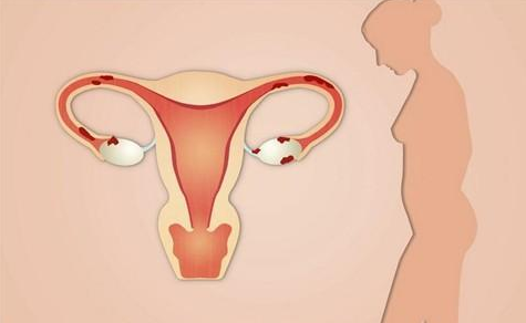 为什么我会长子宫内膜息肉 ，影响怀孕吗?