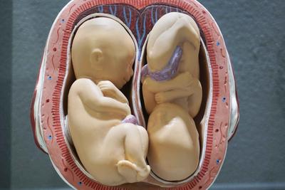 矮个子女性怀双胞胎
